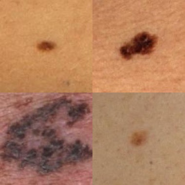 Skin lesion samples